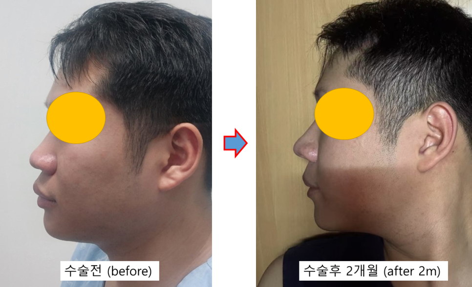 남자 복코 성형, 두꺼운 코끝을 자연스럽게 개선하기 관련 이미지 3
