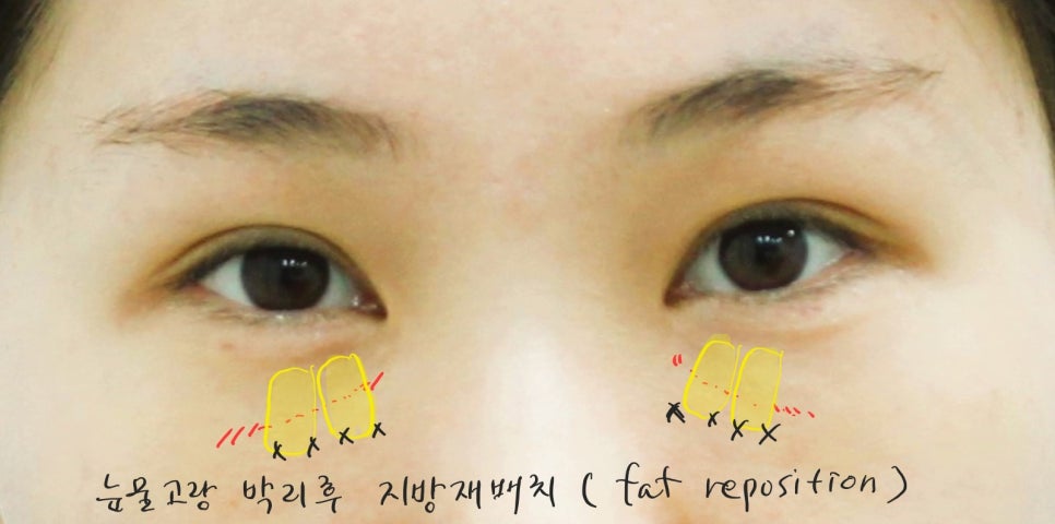 Under-Eye Fat Repositioning and Aegyo-Sal Fat Grafting image 5