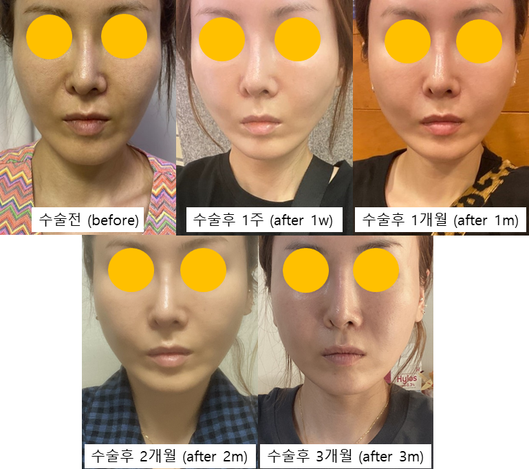안면거상 해부학을 적용한 실리프팅, 오래가고 자연스러운 이유 관련 이미지 3