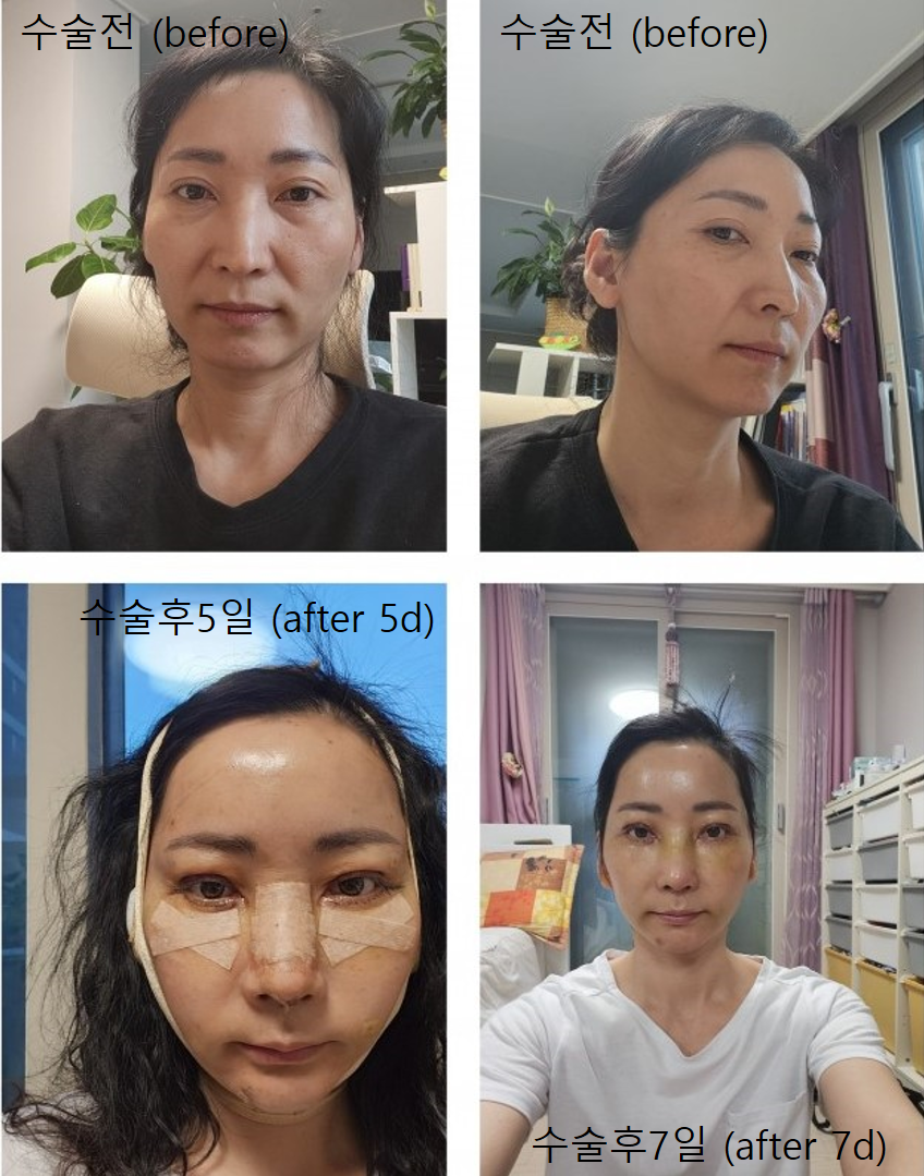 The Surgery Time and Recovery Period for Various Middle-Age Anti-Aging Surgeries image 7
