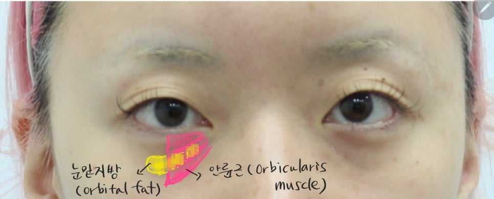 눈밑지방재배치의 회복기간 관련 이미지 3