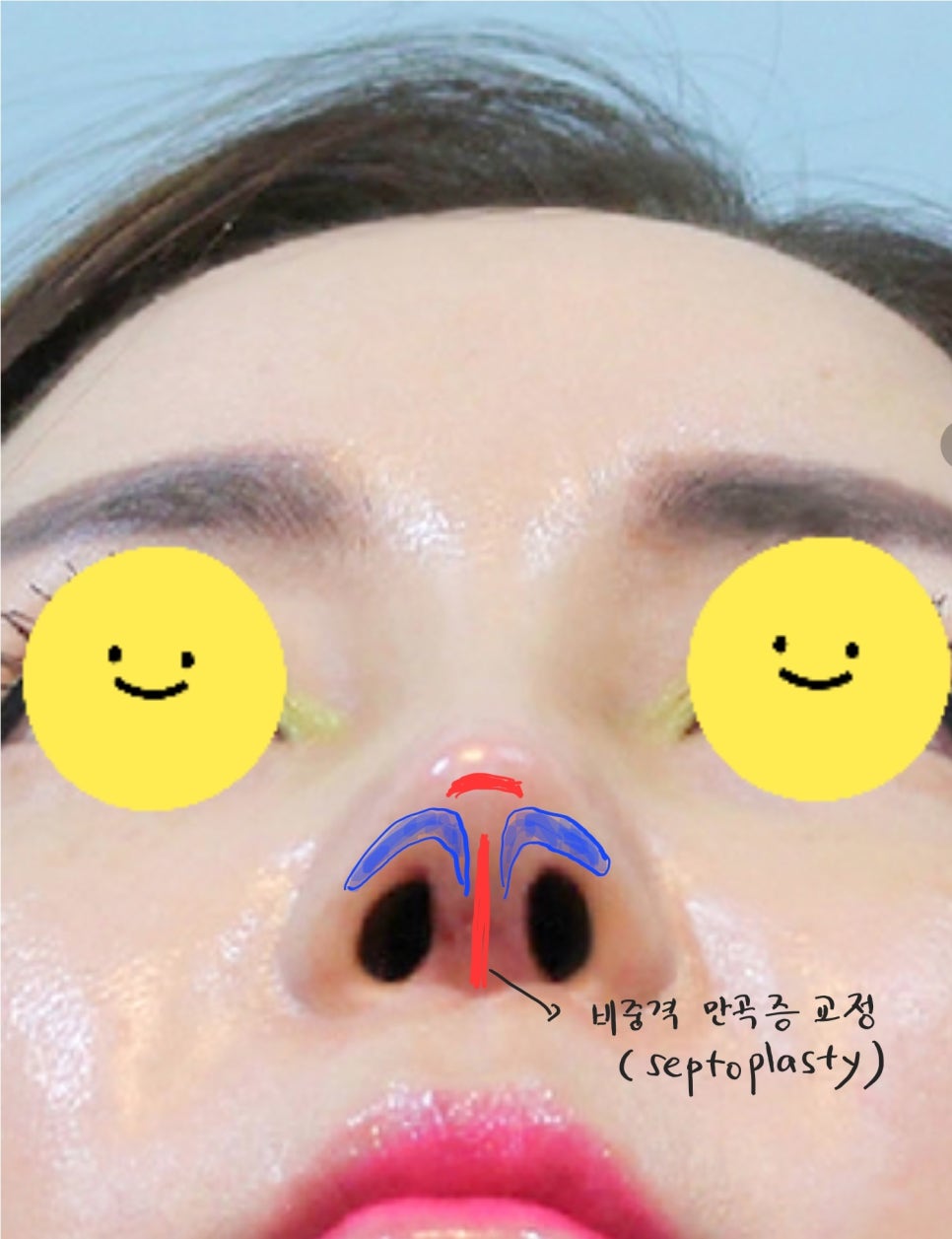 트렌드 변화에 따른 중년코 재수술 관련 이미지 5
