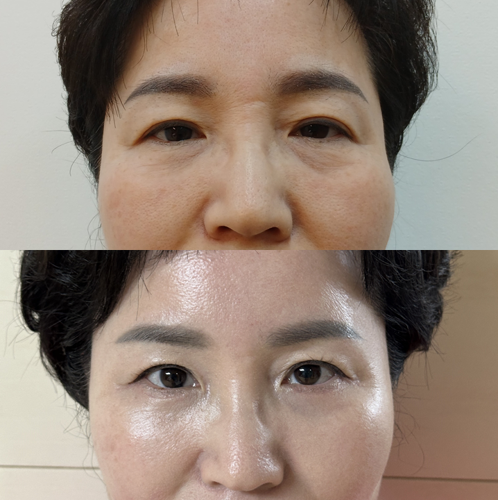 Mother’s Day Top Pick for a Gratitude-Driven Facial Procedure: The Recovery Process After Lower Blepharoplasty A to Z image 5