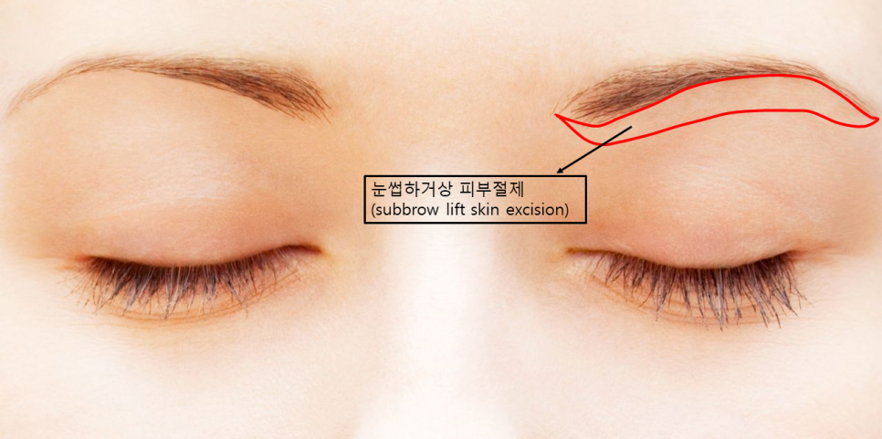 눈썹하거상 흉터, 시간이 지나면서 어떻게 변할까요? 관련 이미지 1