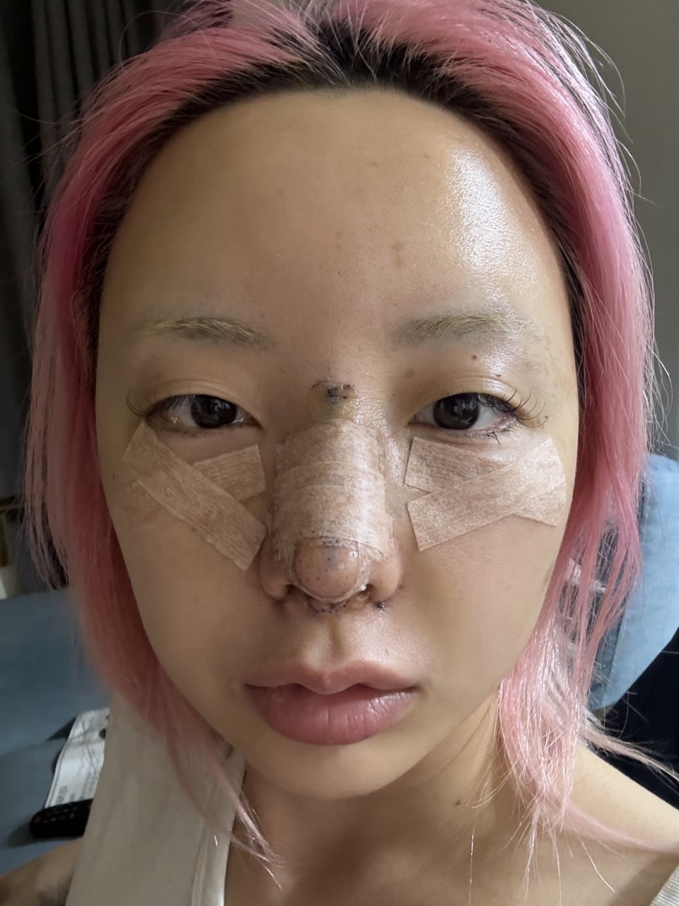 눈밑지방재배치의 회복기간 관련 이미지 6