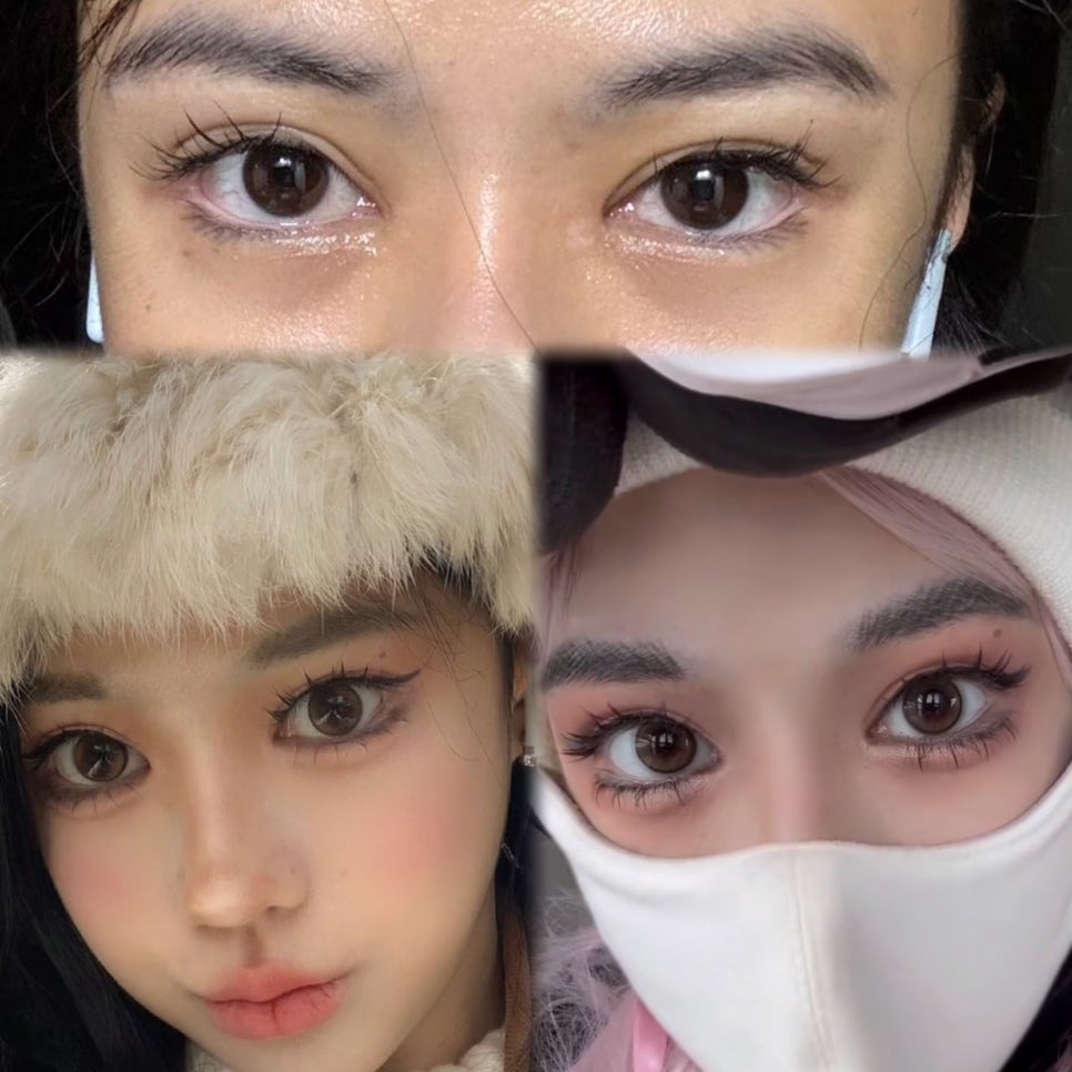 지방이식의 진화: 나노팻 지방이식 관련 이미지 3