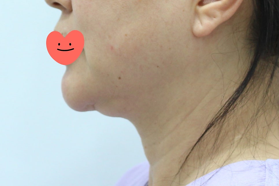 Submental Incision Neck Lift Performed Together with Facelift image 1