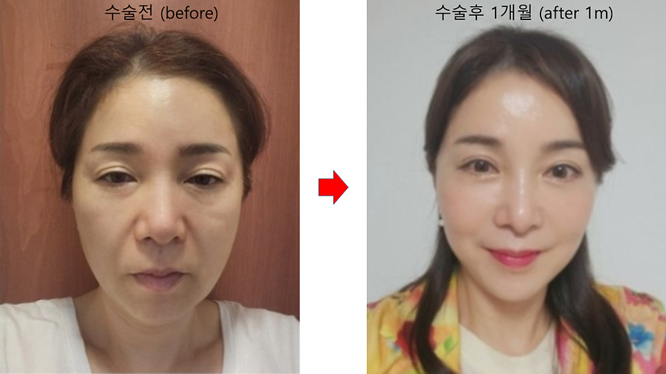 애교살을 보존하는 하안검 수술 관련 이미지 9