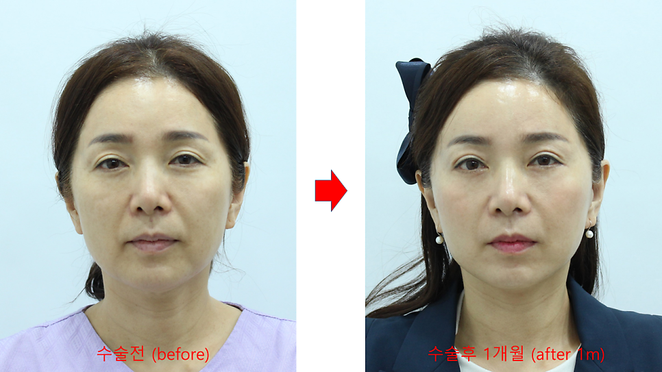 노화의 원인을 교정하는 중년성형 수술 관련 이미지 4
