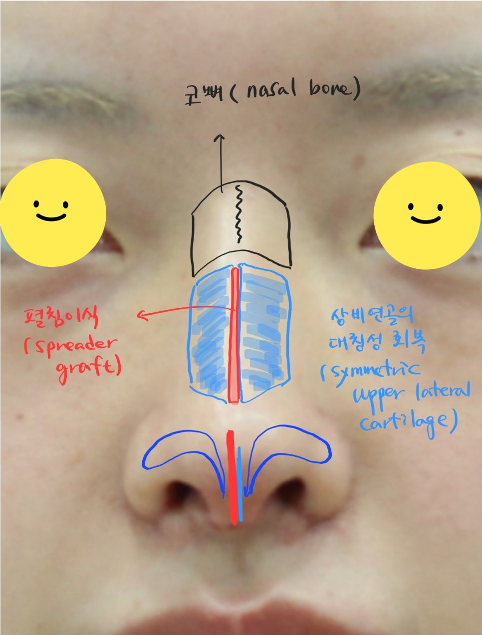 코성형후에 코가 휘었을때의 재수술 관련 이미지 12