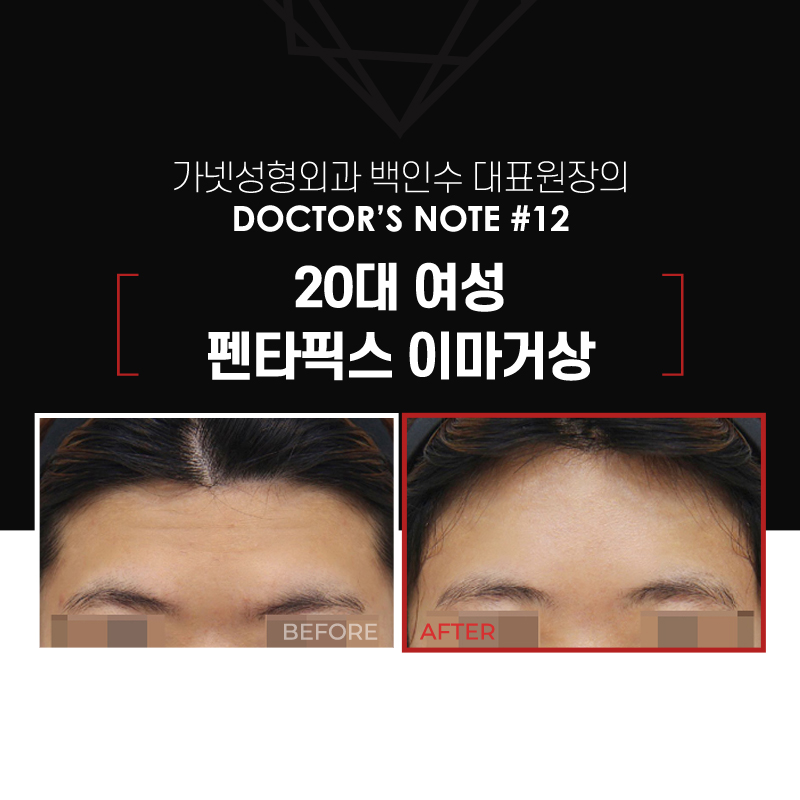 【가넷성형외과 백인수원장 성형칼럼】 20대 여성 펜타픽스 이마거상으로 이마 모양과 눈썹 교정 관련 이미지 2