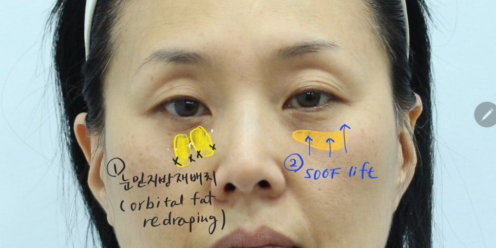 Lower Blepharoplasty in Your 50s to Add Firmness to the Midface image 3