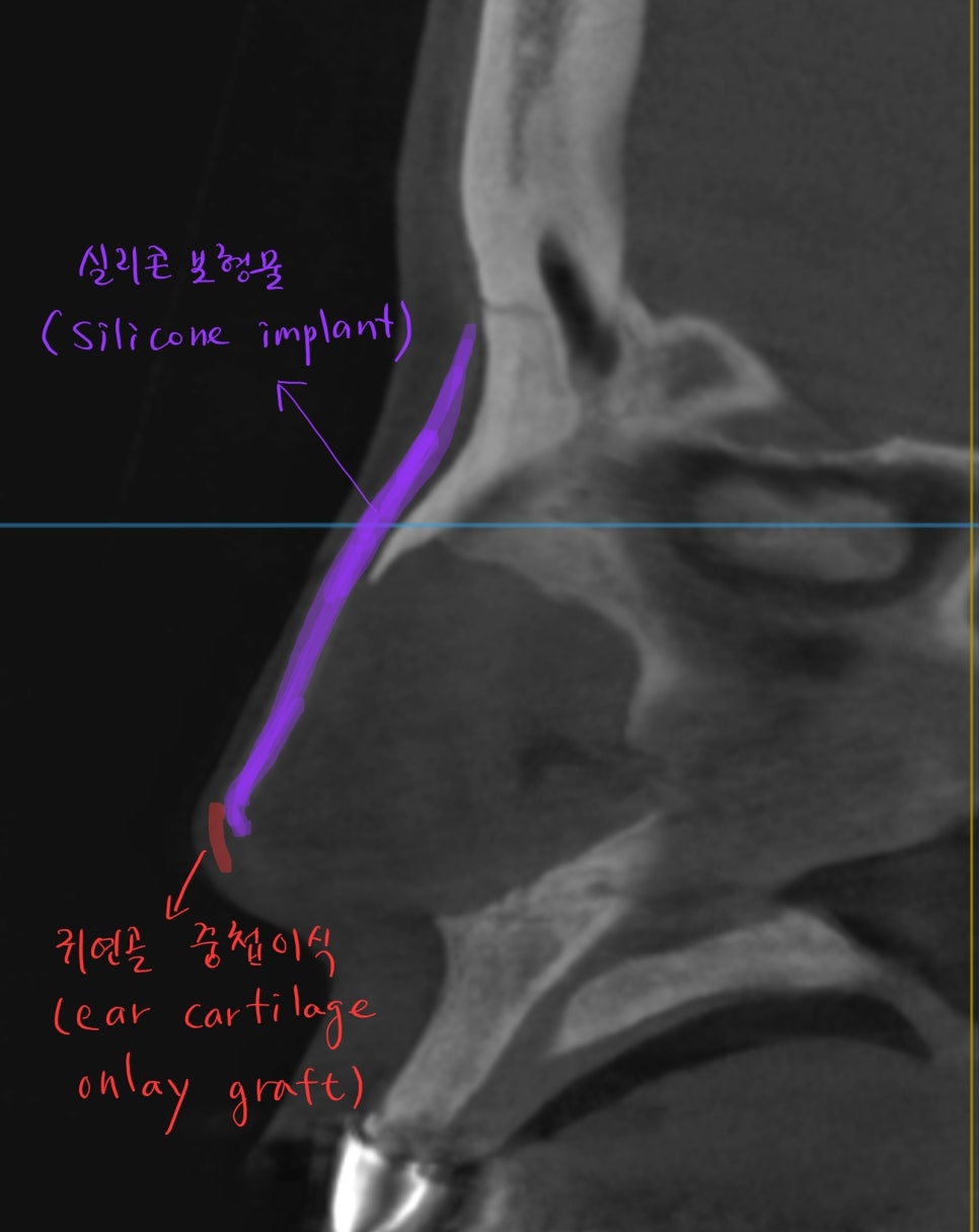 코끝연골이 비치는 경우 중년코재수술 관련 이미지 2