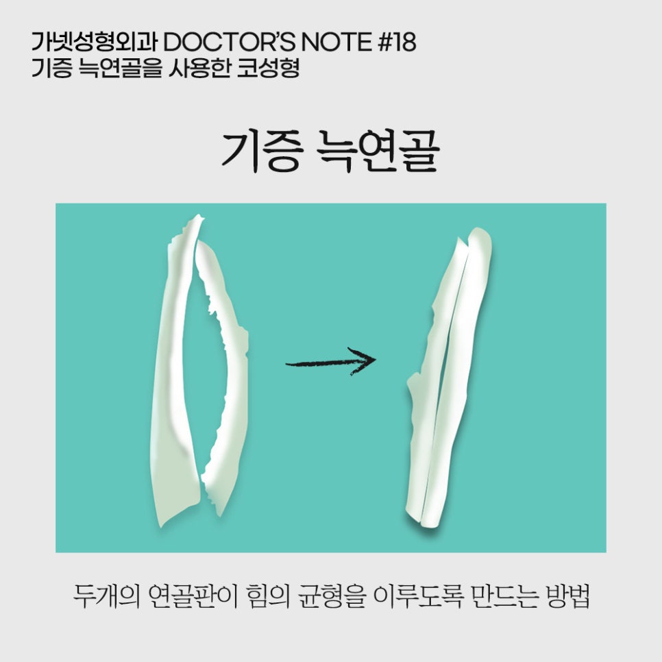 [Garnet Plastic Surgery Director Baek In-soo's Plastic Surgery Column] Rhinoplasty Using Donated Rib Cartilage image 5