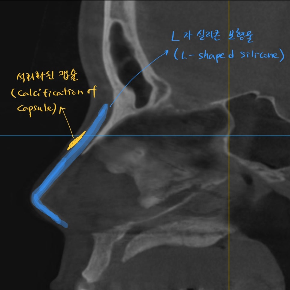Nasal Tip Skin Irritation Caused by L-Shaped Silicone image 3