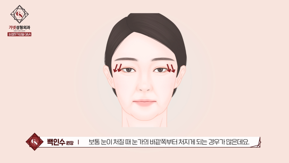 Differences Between Upper Eyelid Lift and Upper Blepharoplasty, and Brow Lift Scars: Explained by a Board-Certified Plastic Surgeon image 2