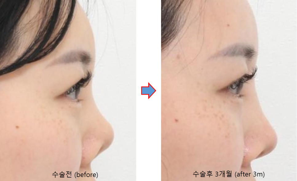 늑연골로 만든 콧대, 정말 흡수될까요? 관련 이미지 6