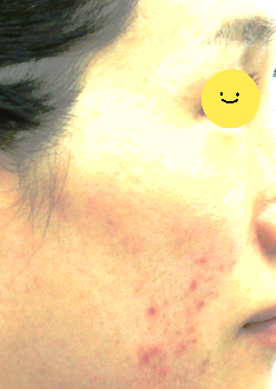 A Specialized Fat Grafting Correction Method for Hollowed Side Cheeks image 2