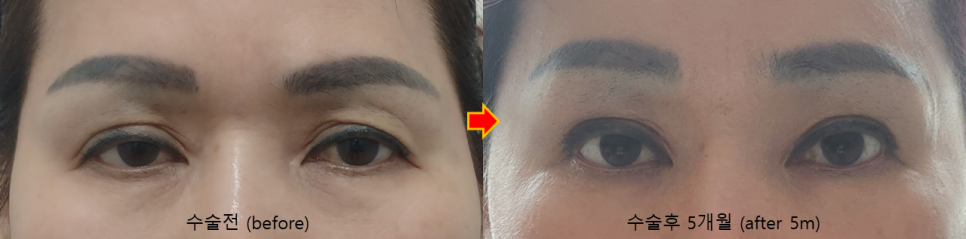 복합적인 눈 문제, 하나의 수술보다 원인별 교정이 중요한 이유 관련 이미지 6