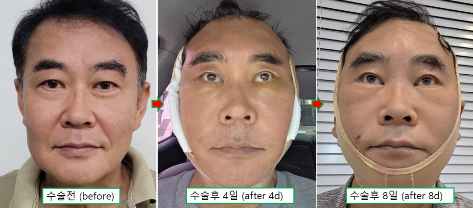 60대 남자 거상수술, 브래드 피트와 비슷한 나이의 실제 수술 사례 관련 이미지 4