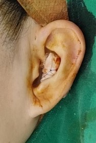 Precautions When Using Ear Cartilage in Rhinoplasty image 3
