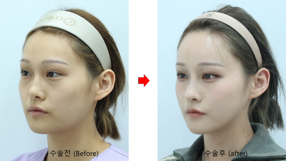 자연스러운 볼륨감을 위한 지방이식 관련 이미지 10