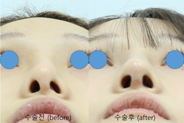 Rib Cartilage Rhinoplasty for a Deviated Saddle Nose image 14
