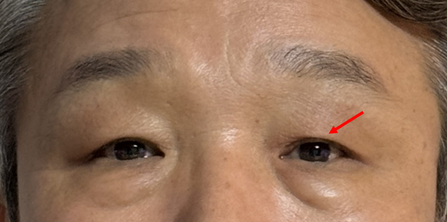 Recovery Process and Natural Impression Changes After Upper and Lower Eyelid Surgery in a Man in His 50s image 2