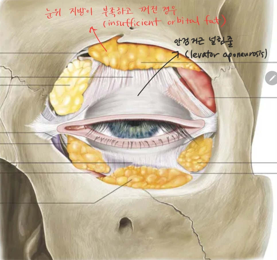 Upper Eyelid Surgery with Upper Eyelid Fat Repositioning image 3