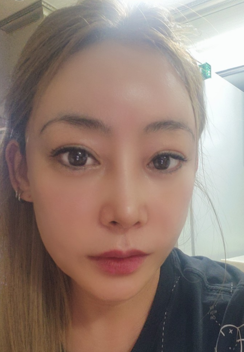 히든(hidden) 미니거상의 수술방법과 회복기간 관련 이미지 7