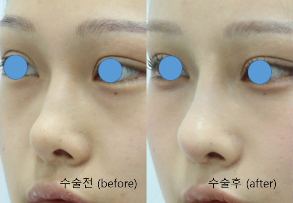 Rib Cartilage Rhinoplasty for a Deviated Saddle Nose image 12