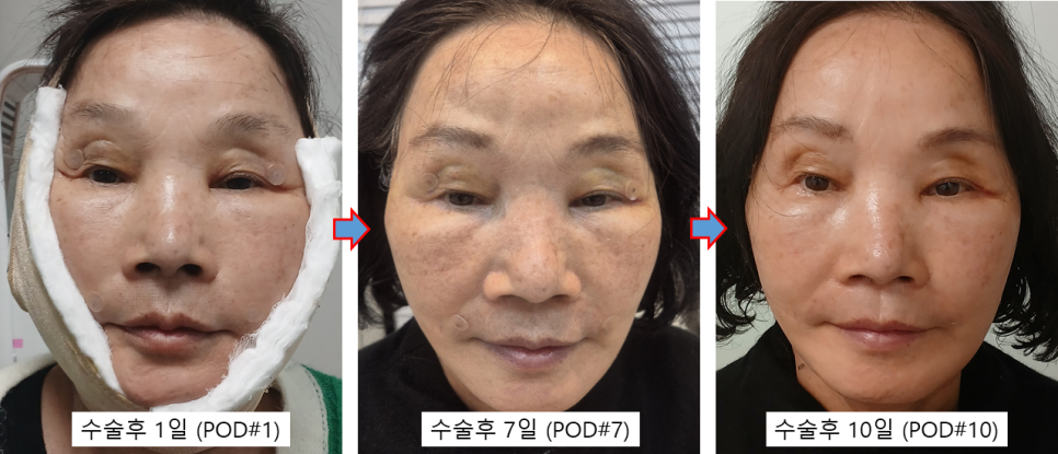 70대 안면거상 가능할까? 회복과정과 3개월 전후 실제 사례 관련 이미지 1