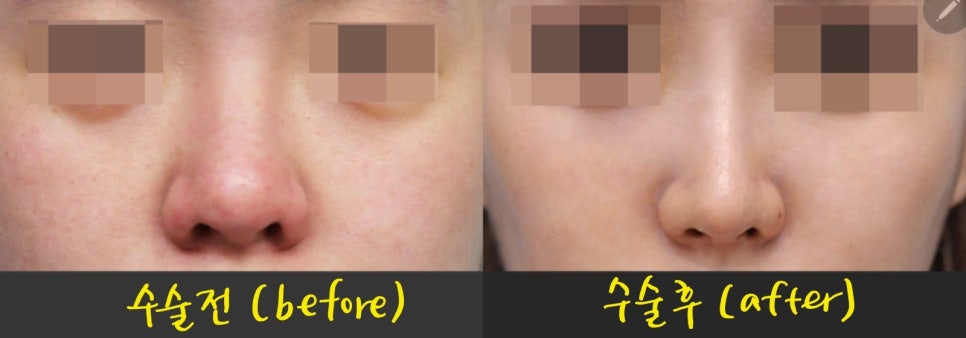 Various Nasal Tip Procedures for Bulbous Nose Correction image 7