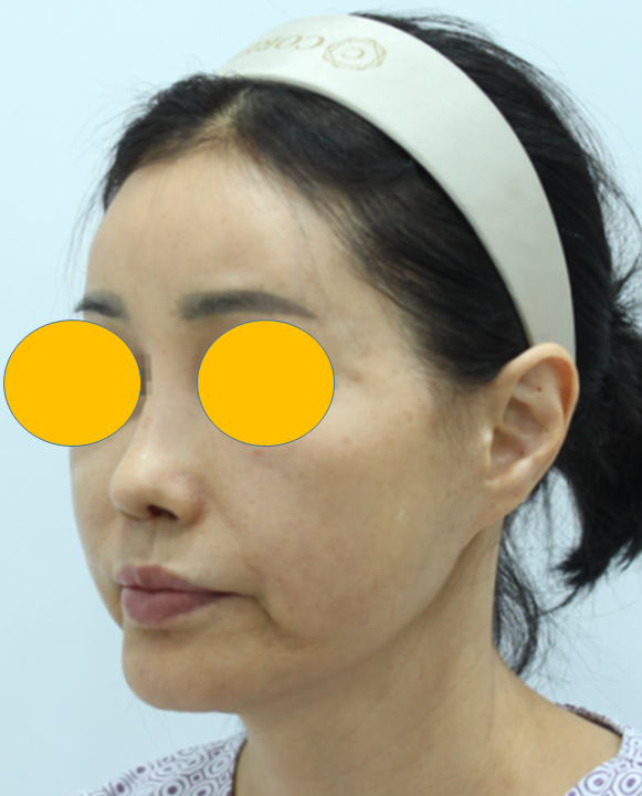 안면거상 재수술에서 수술 방법의 선택 관련 이미지 3