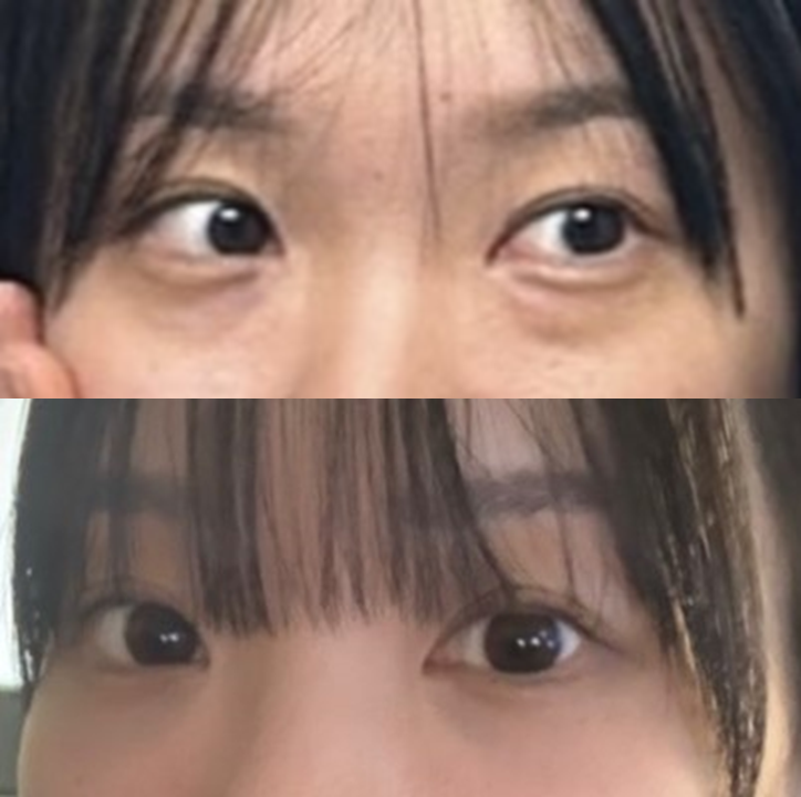 다크서클 없애는 수술, 하나만 꼽는다면? 눈밑지방재배치의 효과 관련 이미지 3