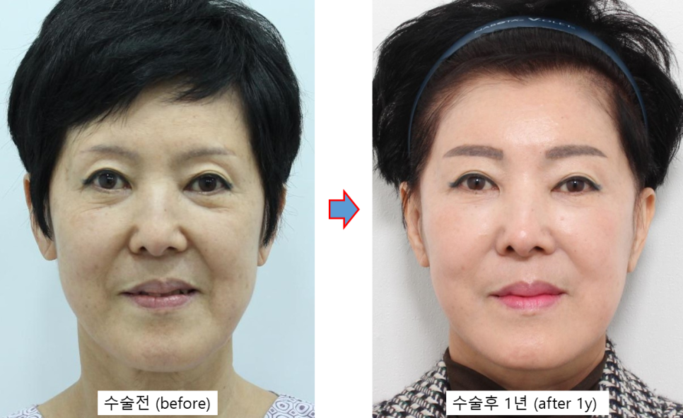 눈밑 수술을 하지 않았는데, 눈밑이 좋아졌습니다 관련 이미지 3