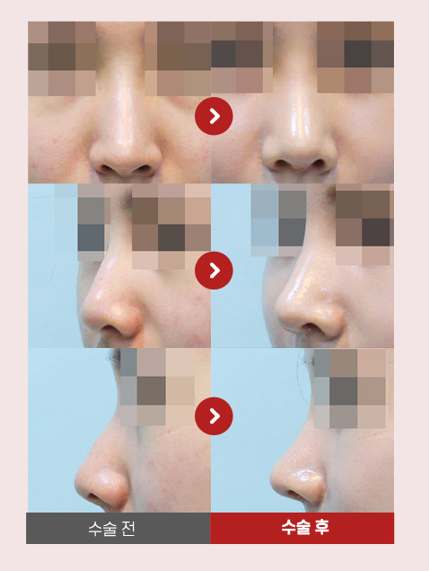 【가넷성형외과 백인수원장 성형칼럼】 매부리코 무보형물코성형 관련 이미지 5