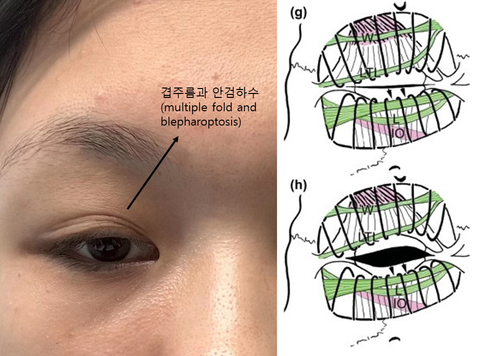 시원한 눈매를 위한 눈매교정 관련 이미지 2