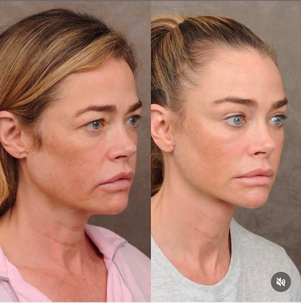 The Result of the $200,000 Anti-Aging Surgery Chosen by a Hollywood Star image 8
