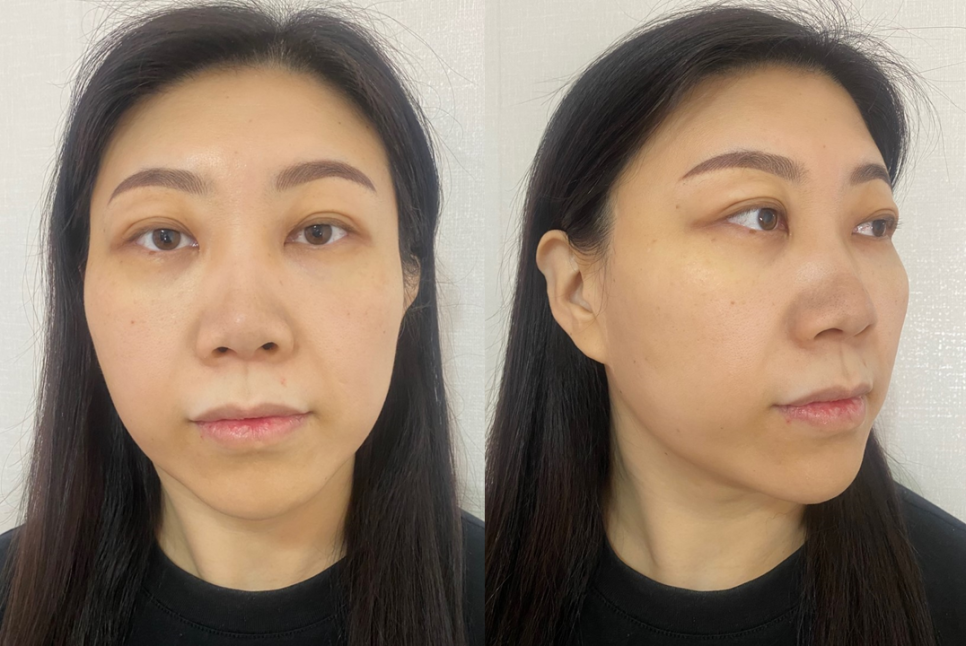 Rhinoplasty + Forehead Fat Grafting: Why the Face’s Mood Changes image 1