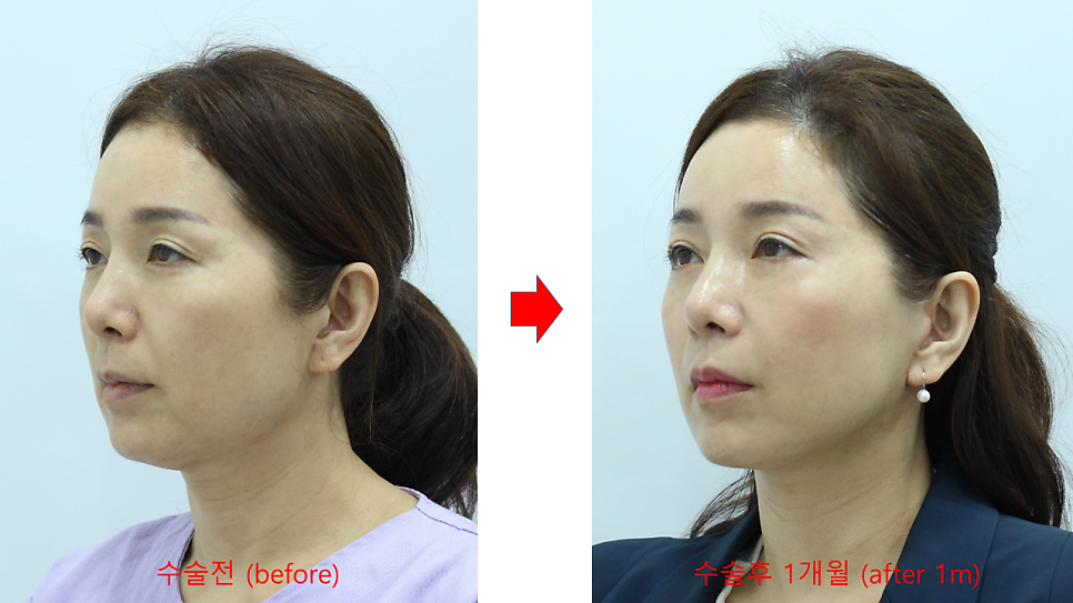 노화의 원인을 교정하는 중년성형 수술 관련 이미지 6