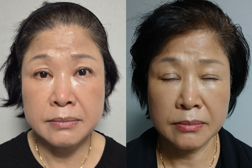 쌍꺼풀 재수술, 함몰흉터는 개선되고 눈은 편해졌습니다 - 6개월 흉터 성숙 과정 관련 이미지 1