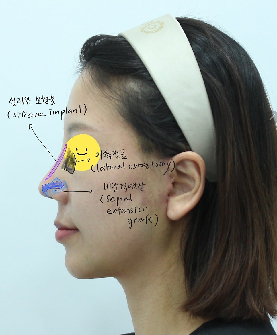 Recovery Period for Midlife Nose Surgery image 2