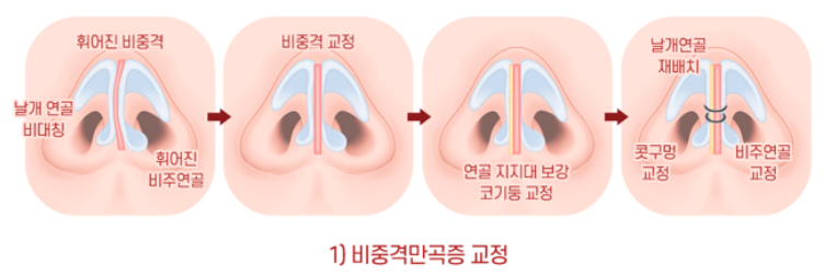 Male Rhinoplasty Performed Alongside Septoplasty image 2