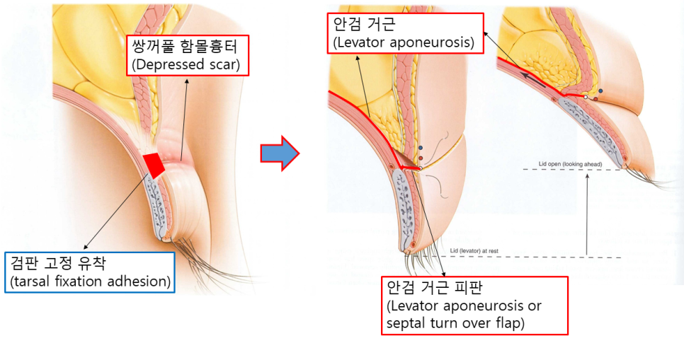 쌍꺼풀 재수술, 함몰흉터는 개선되고 눈은 편해졌습니다 - 6개월 흉터 성숙 과정 관련 이미지 2