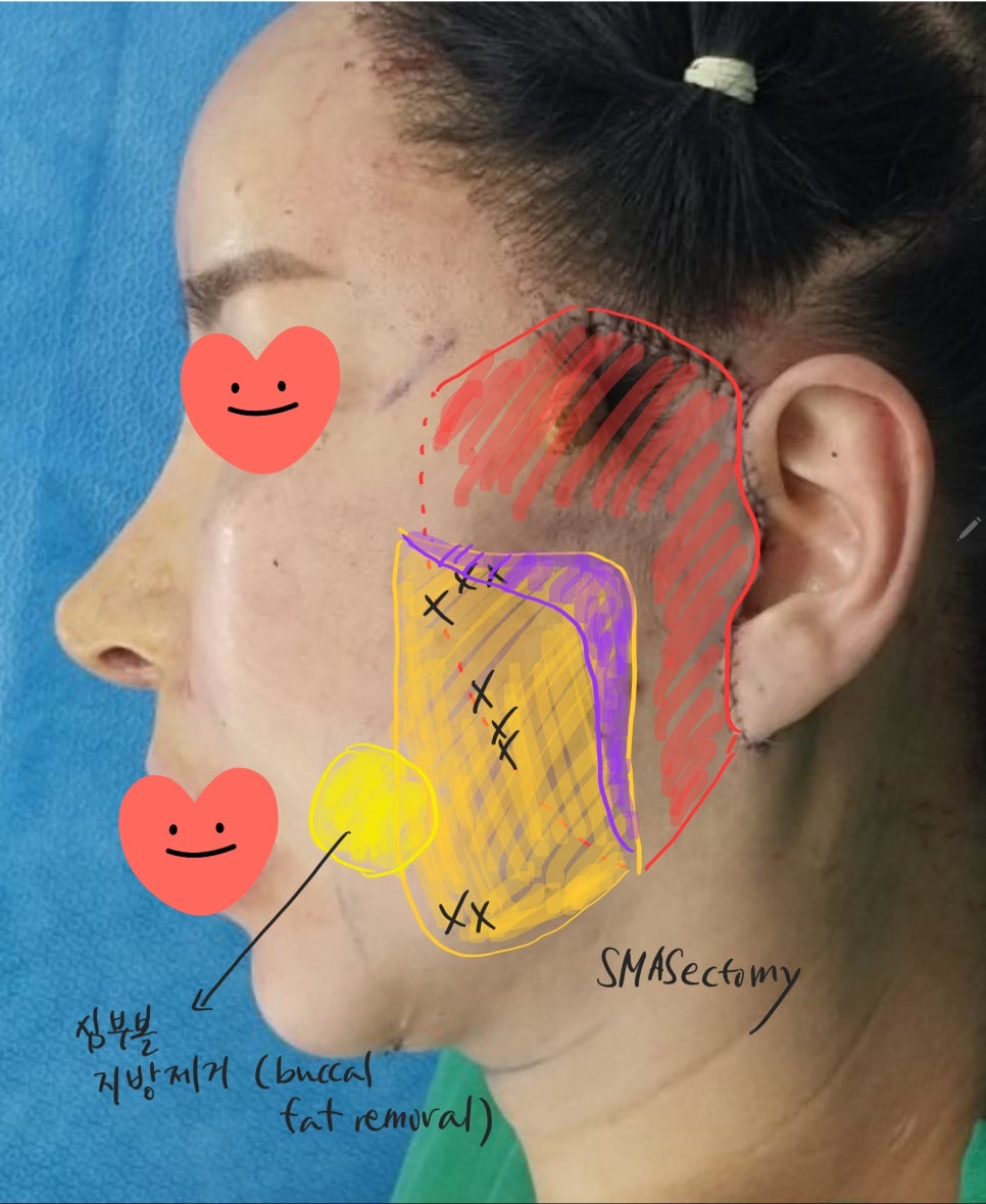 Sagging Skin After Facial Contouring Surgery (Cheek Sagging) image 5