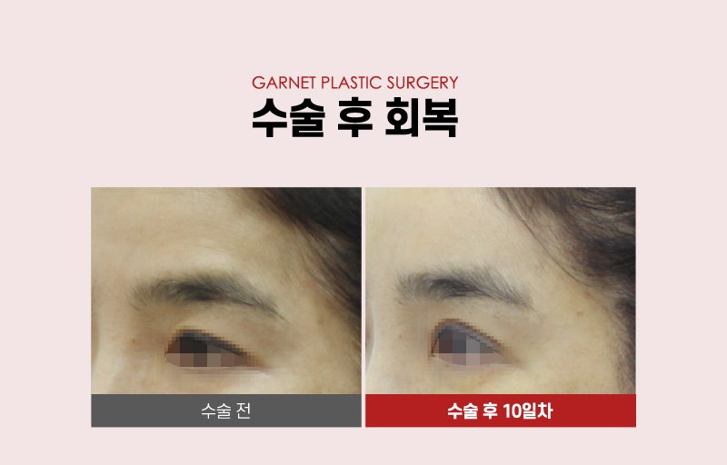 【가넷성형외과 백인수원장 성형칼럼】 50대 여성 이마거상 후 빠른 회복 관련 이미지 6