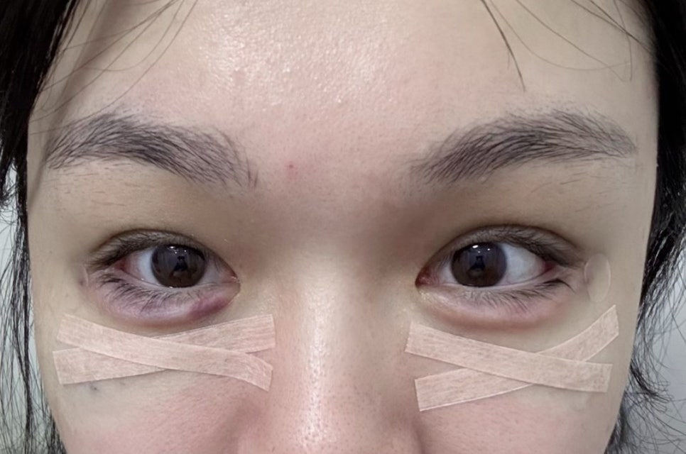 안전한 눈밑지방재배치를 위한 수술기구와 방법 관련 이미지 7
