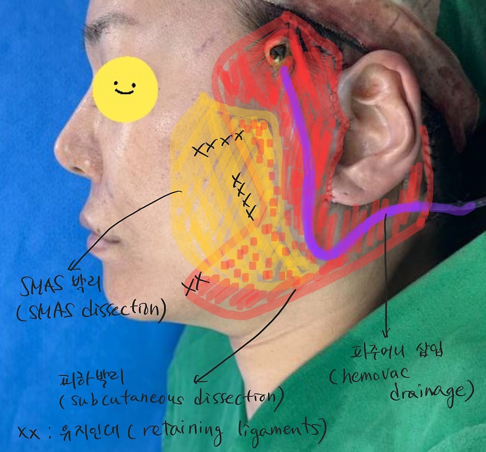노화에 따른 얼굴형의 변화 관련 이미지 4