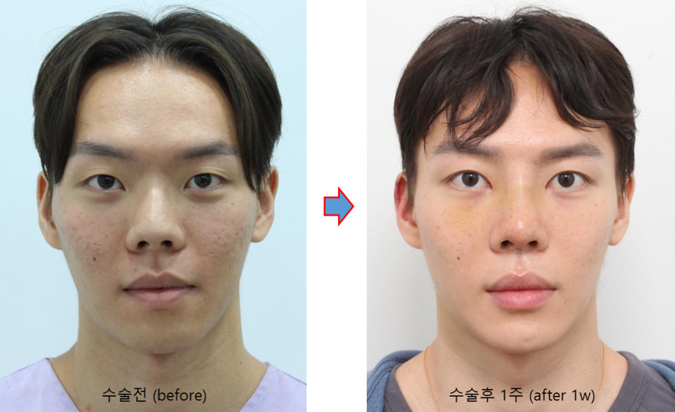 코뼈를 깎지 않는 코성형? 3D CT 맞춤형 코보형물 관련 이미지 3